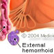 Hemorrhoids (Piles)