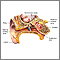 Ear barotrauma
