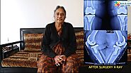 Sidha Bhargawa Done Robotic Knee Replacement Surgery in Mulund, Mumbai | Dr. Shailendra Patil Mumbai