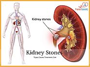 Best Diet to Prevent Kidney Stones