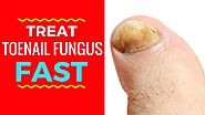 3 Quick Toenail Fungus Treatments - How To Treat Toenail Fungus Fast