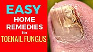 Easy Home Remedies for Toenail Fungus - How to Get Rid of Toenail Fungus Effectively