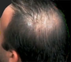 Researchers Report Progress With Growing Hair - WebMD