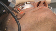 New procedure gets rid of acne scars in one treatment