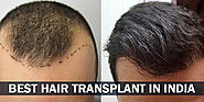 Best Hair Transplant In India