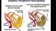 Peripheral Diabetic Neuropathy: Symptoms, Causes and Treatments