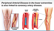What is peripheral obstructive arterial disease (RAA) - Artery stenosis and blockage
