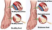 Peripheral Neuropathy - Symptoms, Types and Causes of Peripheral - Men's Health Problems