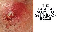 Home Remedies for Boils: The Easiest Ways to Get Rid of Boils