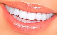 Dental Veneers Treatment in Cancun Mexico