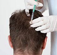 How Mesotherapy is Helpful in Reducing Hair Loss?