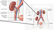 Procedural understanding of Kidney Transplant | Medmonks