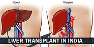 Liver Transplant In India