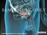 Prostate Cancer Surgery