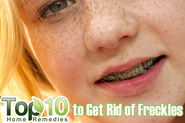 Home Remedies to Get Rid Of Freckles