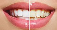 Why Dentists are better option for long lasting teeth whitening?