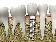 ایمپلنت دندان چیست و چه انتظاراتی از آن می توانید داشته باشید؟ | کلینیک آیریس