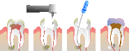 Root Canal Treatment in Calgary NW