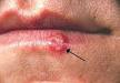 Epidemiology of herpes simplex - Wikipedia, the free encyclopedia