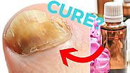 Fast Toenail Fungus Cure? - How to Get Rid of Toenail Fungus (With Nail Fungus Treatment)