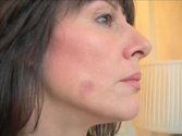 Age Spots Removal Totally at Home in 14 days