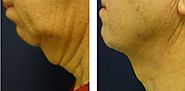 Neck Lift Surgery - Results, Risks, Recovery- Everything you can find here