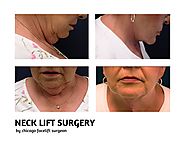 Neck Lift Surgery - Results, risks and Recovery