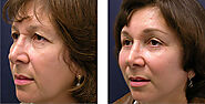 Find Best Facelift Surgery Center Chicago - United States