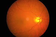 Anti–Vascular Endothelial Growth Factor Therapy (Anti VEGF Therapy) for Eye Disorders and Cancers