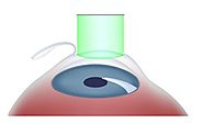 Lasik Surgery (Laser Eye Surgery): Procedure, Side Effects, Risks, Complications, Blindness
