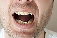 Signs and Symptoms of Dental Caries (Dental Cavities or Tooth Decay)