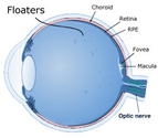 Eye Floater Treatment & Prevention