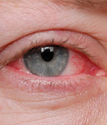 Natural Remedies for the Treatment of Chronic Blepharitis