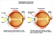 Presbyopia: Causes, Symptoms and Prevention