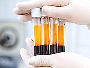 Is Platelet-Rich Plasma (PRP) a Safe and Effective Treatment for Osteoarthritis of the Knee?