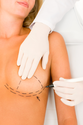 At What Age can a Woman Undergo Breast Reduction?