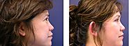 How to find the best minimal incision facelift organization?