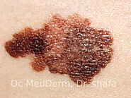 Skin cancer, melanoma, and non-melanoma
