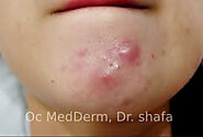 When should I see a Doctor for my acne?