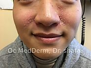 What is Dermatitis? | OC MedDerm