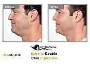 Double chin treatment irvine | Kybella Reduction