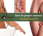 Genital Warts Treatment by Dr. Parvin Shafa