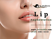 Lip Augmentation with Fillers Irvine | OC MedDerm