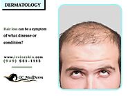 Alopecia Hair Loss | OC MedDerm | Irvine, California