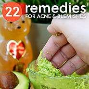 22 Home Remedies for Acne & Pesky Pimples