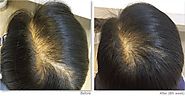 Follicle - Comparison between Minoxidil and Grey Hair Defy