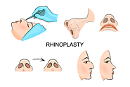Know More about Nose Correction Surgery or Rhinoplasty