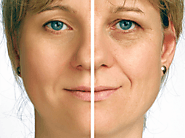 What is Rhytidectomy or Facelift Surgery?