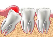 Wisdom Teeth Removal Cost, Procedure, Risks, And Recovery