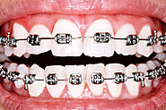 dentist in jaipur|dental clinic in jaipur|dental implant in jaipur|root canal treatment In jaipur
